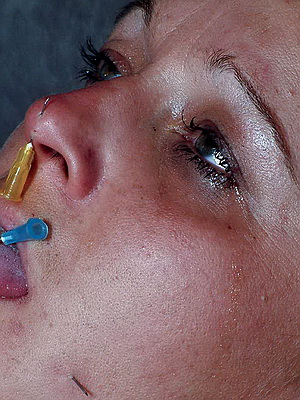 Facial Needle Pain