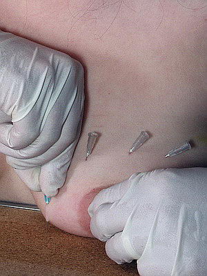 Tit Torment and Needle Pain