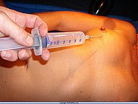 Amateur Needle Pain