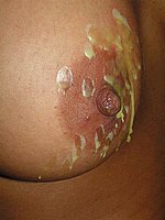 Tit Torment and Needle Pain