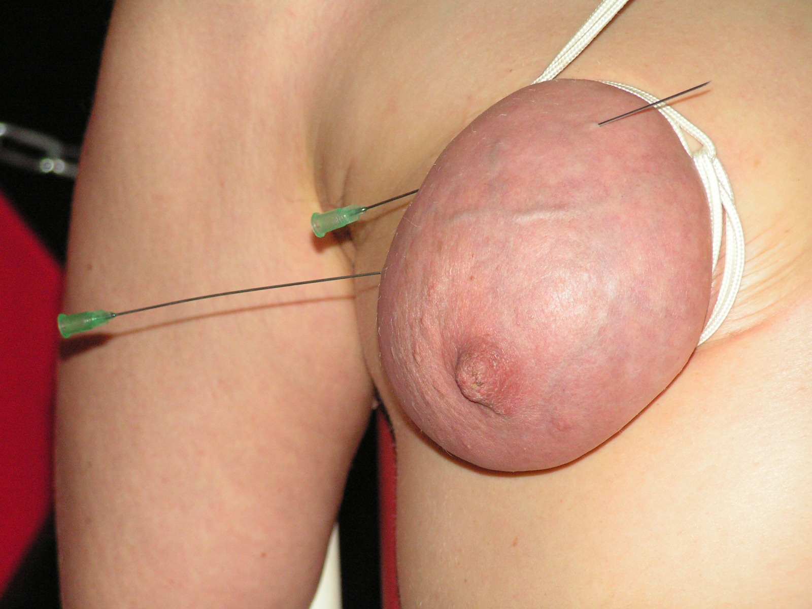 Extreme breast saline injection pics